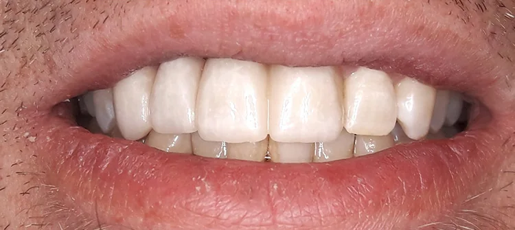 Fall 1: Ergebnis – Vollkeramische Kronen und Veneers im Frontzahnbereich