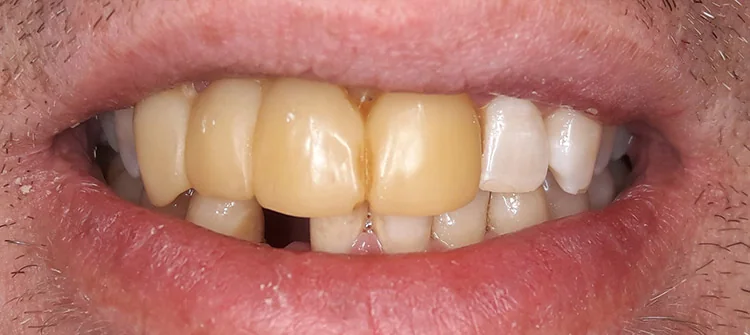 Fall 1: Ausgangssituation – Vollkeramische Kronen und Veneers im Frontzahnbereich